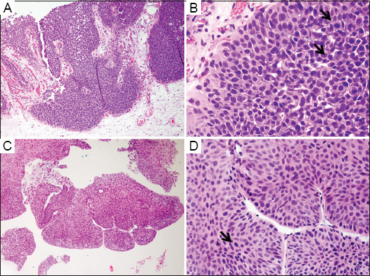 Predictive value of mitotic figure counts in tumor progression of non-invasive high-grade papillary urothelial carcinoma of the urinary bladder: A retrospective study from a single cancer center.
