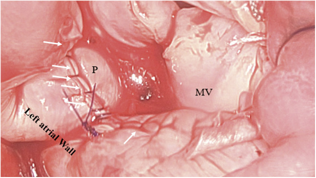 "A Bridge-over-the Bar": A Novel Strategy to Prevent Paravalvular Regurgitation during Mitral Valve Replacement for Severe Mitral Annular Calcifications.
