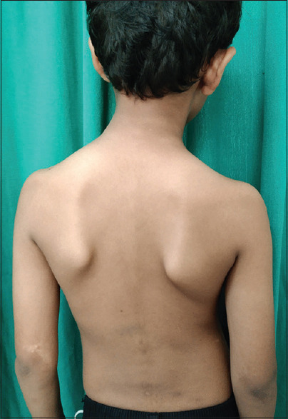 Waardenburg Syndrome in a Family.