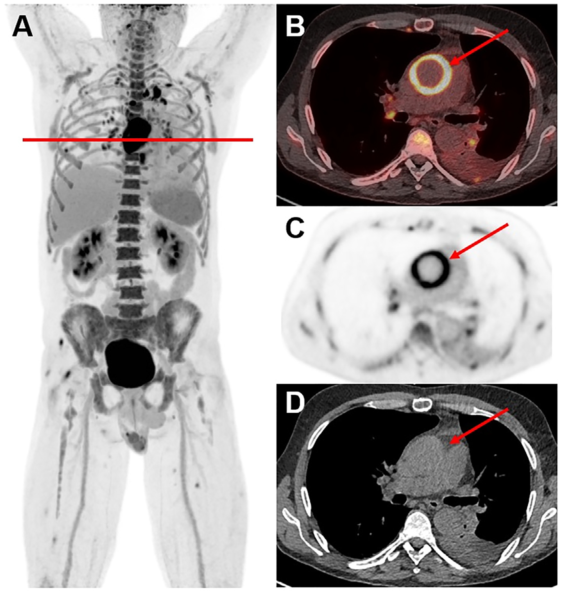 Role of Total Body PET/CT in Inflammatory Disorders