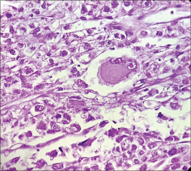 Malignant Perivascular Epithelioid Cell Tumor of Ovary: A Rare Case Report.