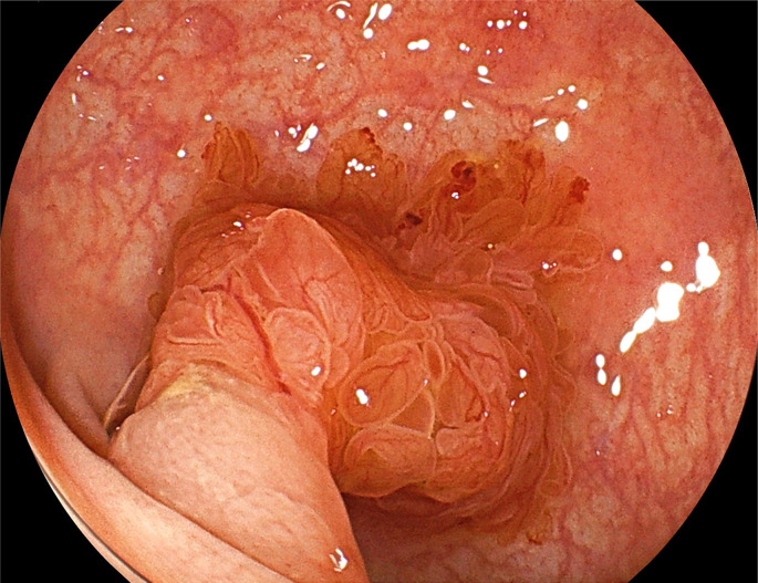 Endoscopic and Clinicopathological Features of a Colorectal Mucin-Rich Variant of Traditional Serrated Adenoma.