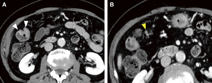 Spontaneous Regression of Advanced Transverse Colon Cancer: A Case Report.