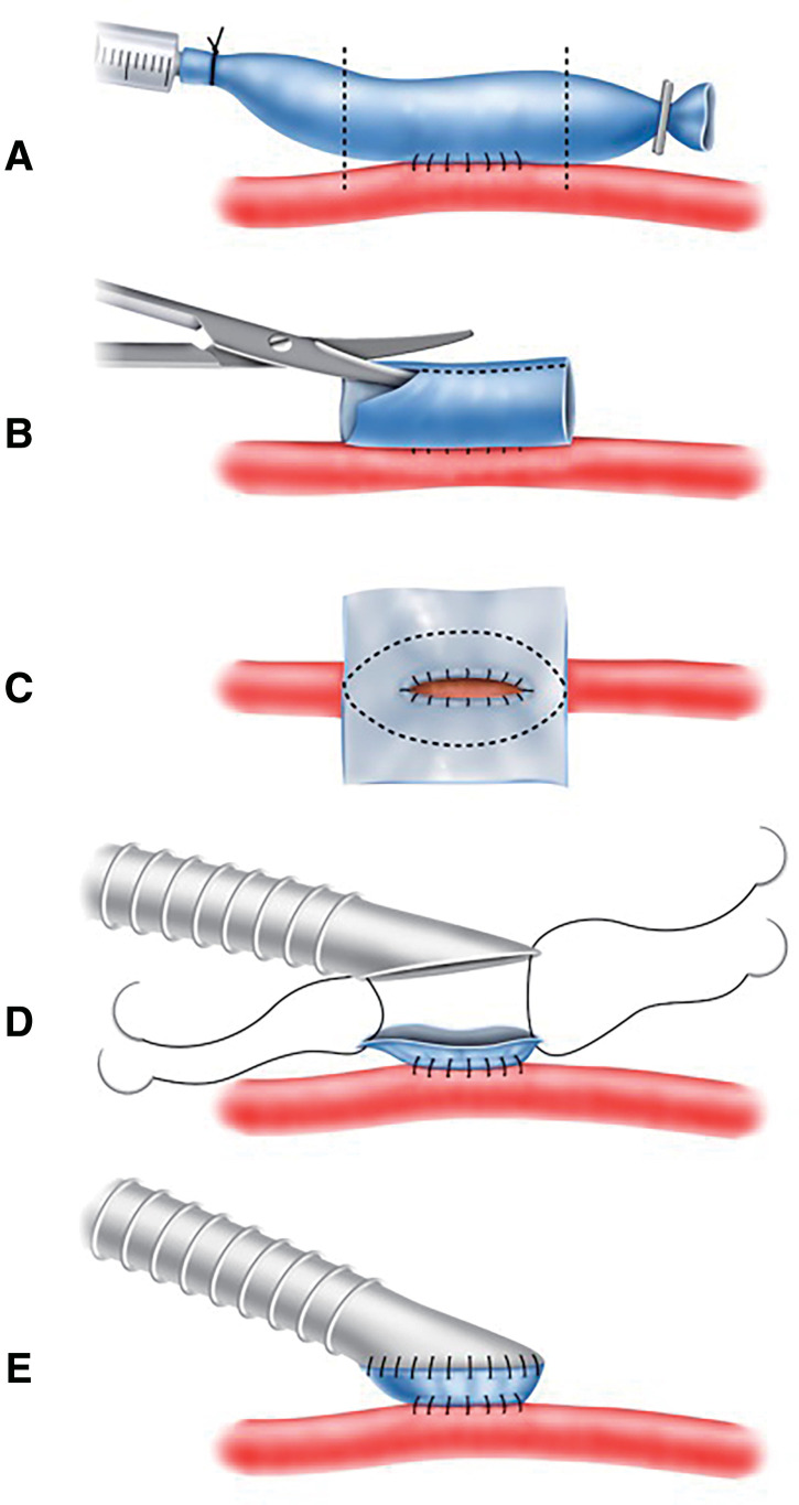 Surgical Outcomes of the Boat-Form Vein Cuff Technique in Peripheral Artery Bypass Grafting.