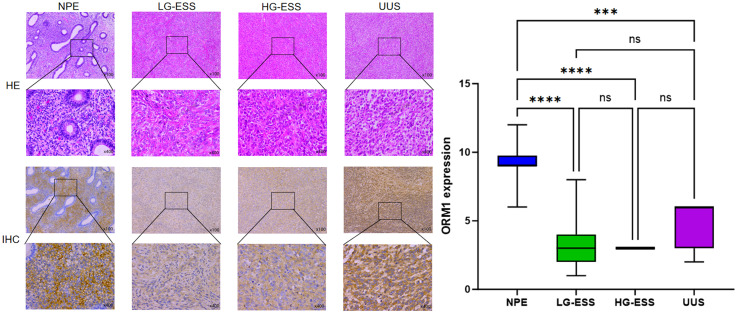 Orosomucoid 1 is a Potential Prognostic Biomarker for Uterine Sarcoma.