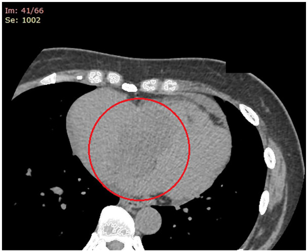 Giant Right Atrial Myxoma Presenting With Right Heart Failure.