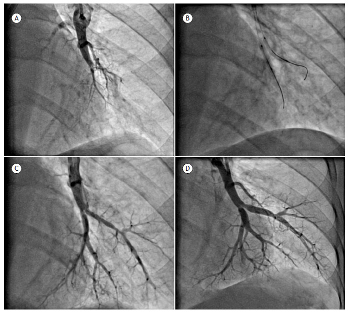 Balloon pulmonary angioplasty in patients with chronic thromboembolic pulmonary hypertension: short- and long-term results from a cohort in Brazil.