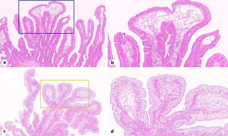 Endoscopic and Clinicopathological Features of a Colorectal Mucin-Rich Variant of Traditional Serrated Adenoma.
