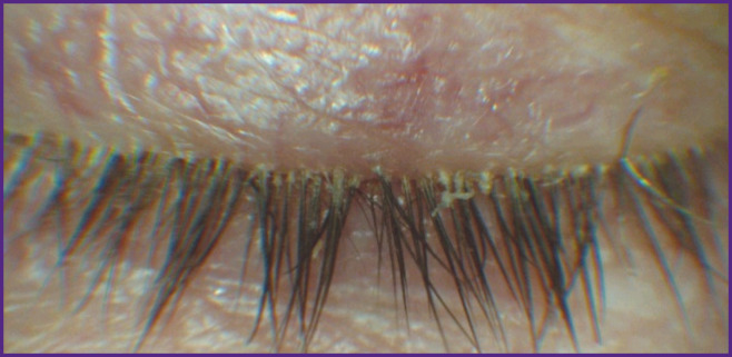 Modern Technologies in <i>Demodex</i> Blepharitis Diagnosis and Therapy (Review).