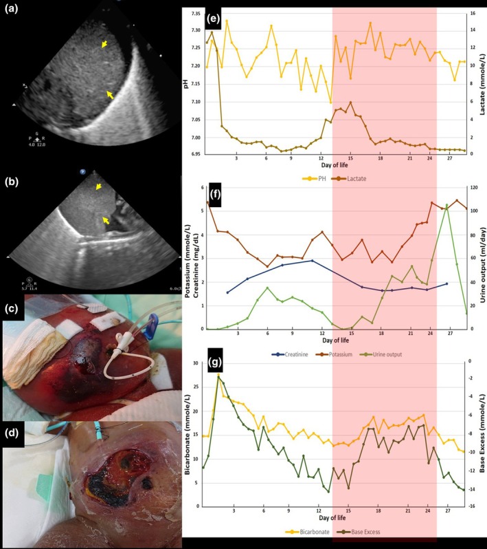 Peritoneal dialysis in an ELBW infant after resolution of hemoperitoneum: Challenges with peritonitis and cellulitis.