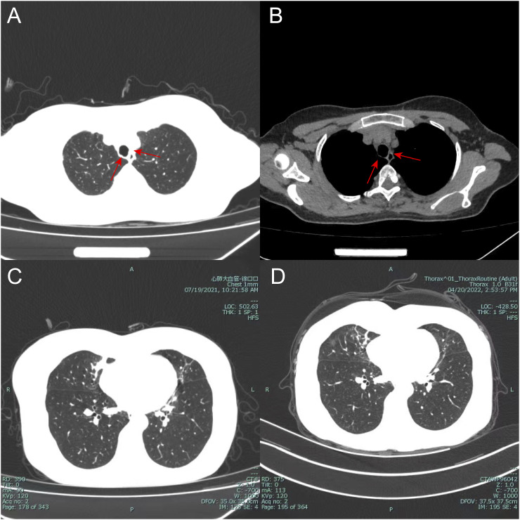 Tracheal mucosal keratosis: Case discussion and literature review.