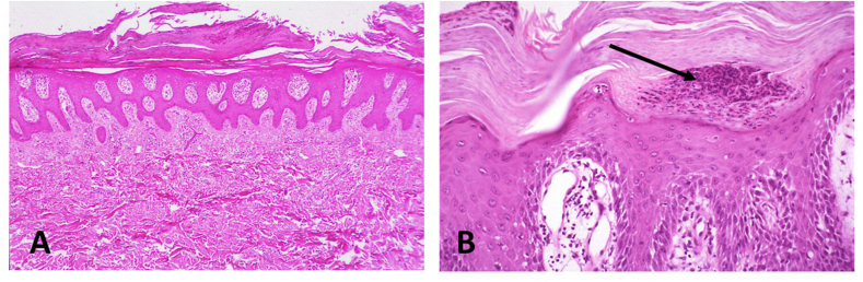 Educational Case: Psoriasis