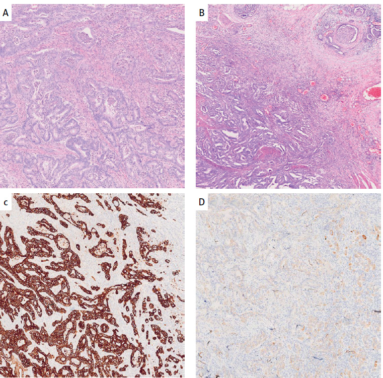 Multimodal treatment for long-term survival in ampullary adenocarcinoma metastatic to the liver.