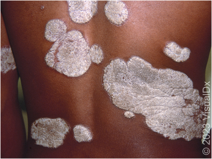 Educational Case: Psoriasis