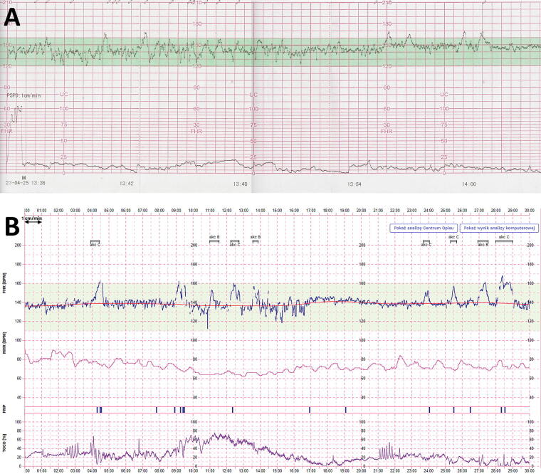 Home Cardiotocography in High-Risk Pregnancies: A Retrospective Study on Feasibility and Patient Well-Being.