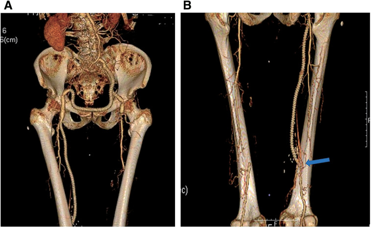 Surgical Outcomes of the Boat-Form Vein Cuff Technique in Peripheral Artery Bypass Grafting.