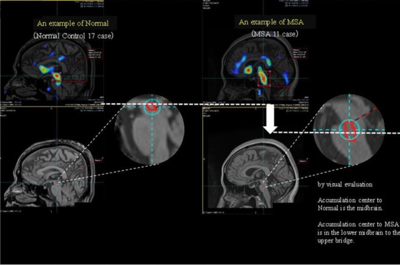 Use of the specific binding ratio distribution to characterise multiple system atrophy in advanced iodine-123-labelled N-(3-fluoropropyl)-2β-carbomethoxy-3β-(4-iodophenyl) nortropane serotonin transporter imaging.