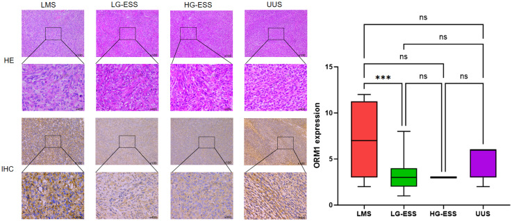 Orosomucoid 1 is a Potential Prognostic Biomarker for Uterine Sarcoma.