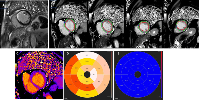Machine learning-based interpretation of non-contrast feature tracking strain analysis and T1/T2 mapping for assessing myocardial viability.