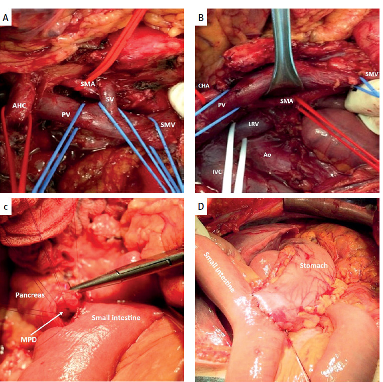 Multimodal treatment for long-term survival in ampullary adenocarcinoma metastatic to the liver.