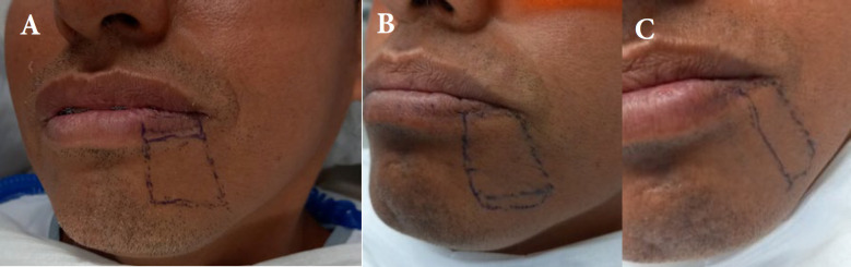 Mental Nerve Paresthesia, a Complication of Anesthesia in Non-surgical Endodontic Treatment: A Case Report .