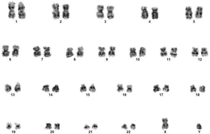 Automated karyogram analysis for early detection of genetic and neurodegenerative disorders: a hybrid machine learning approach.