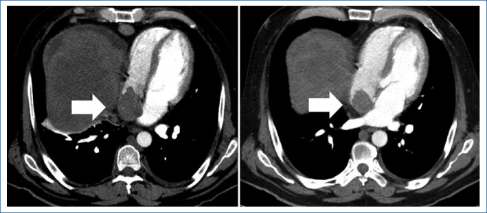 Hepatocellular carcinoma with inferior vena cava tumor thrombus extending into cardiac chambers: case report.