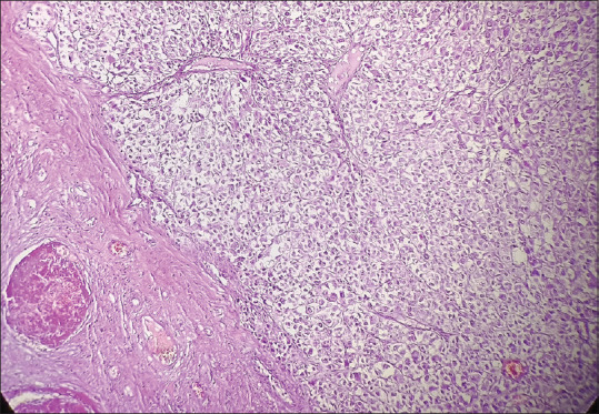 Malignant Perivascular Epithelioid Cell Tumor of Ovary: A Rare Case Report.