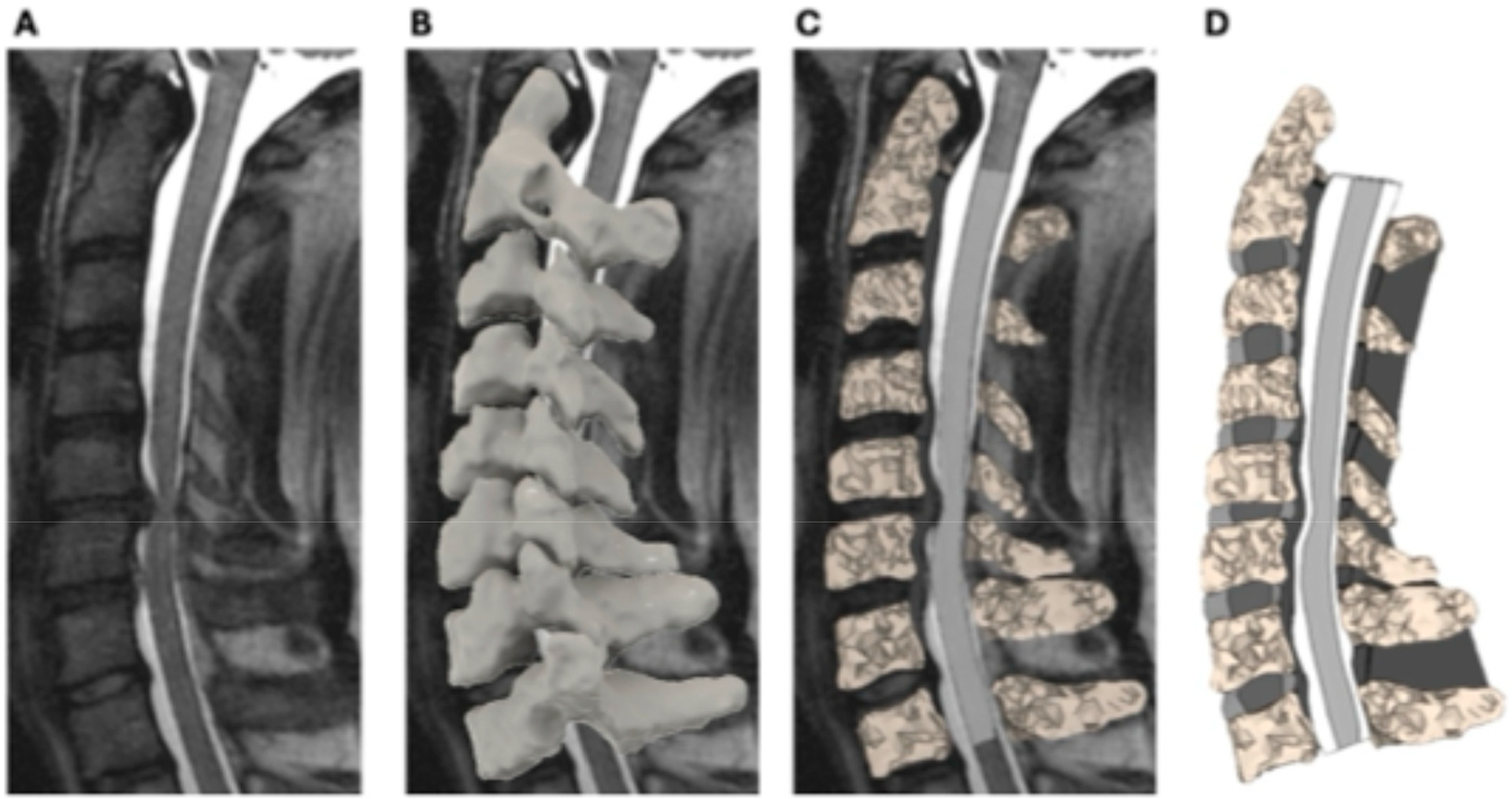 Intramedullary Stress and Strain Correlate with Neurological Dysfunction in Degenerative Cervical Myelopathy.