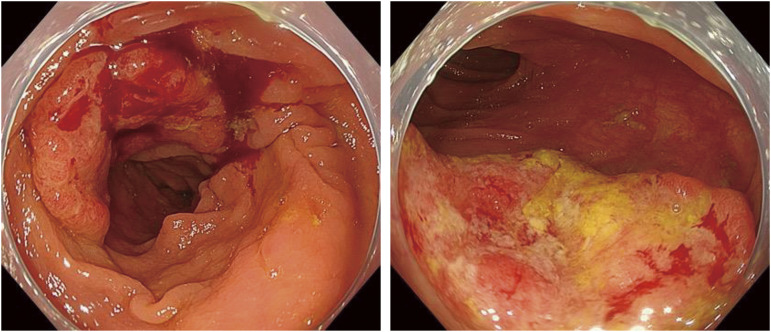 Spontaneous Regression of Advanced Transverse Colon Cancer: A Case Report.