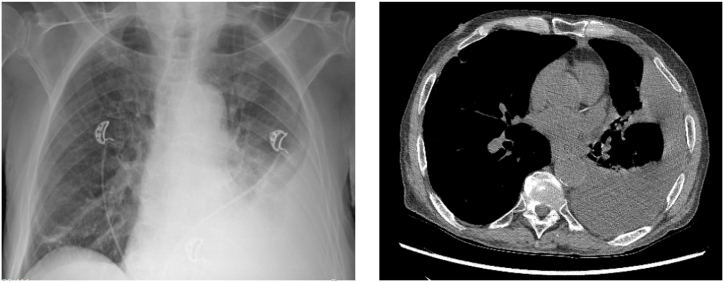 Pancreatopleural fistula: A rare cause of recurrent pleural effusion