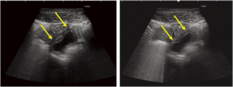Adult Cystic Intestinal Duplication of the Ileum Laparoscopically Resected after Preoperative Diagnosis with Cine Magnetic Resonance Imaging and Abdominal Ultrasound: A Case Report.