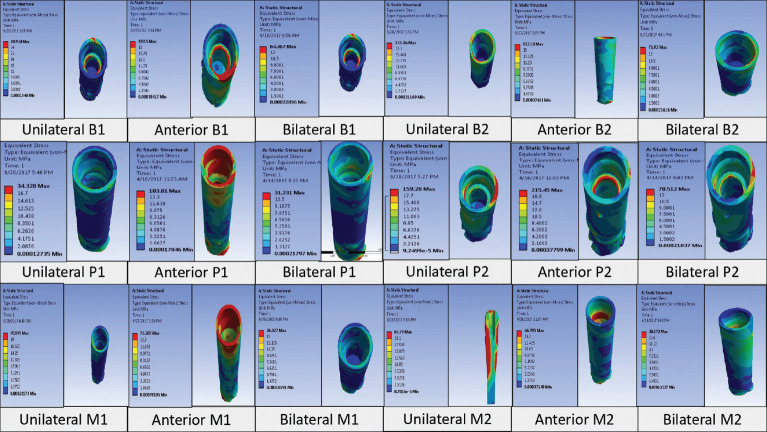Comparative evaluation of pattern and distribution of stresses in single- and double-implant overdenture using ball-ring, positioner, and magnet-keeper attachment under different loading conditions: A finite element analysis.