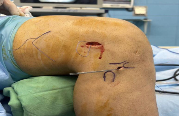 Differences in Clinical Outcomes and Rotational Stability Between Anterolateral Ligament Reconstruction and Lemaire Lateral Tenodesis Following Primary Anterior Cruciate Ligament Reconstruction.
