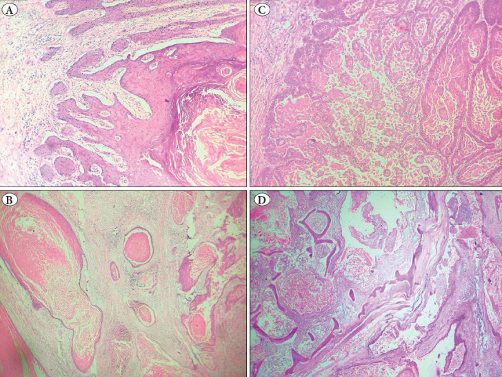 Carcinoma Cuniculatum Masquerading as Eumycetoma: An Unacquainted Entity Posing a Diagnostic Dilemma.