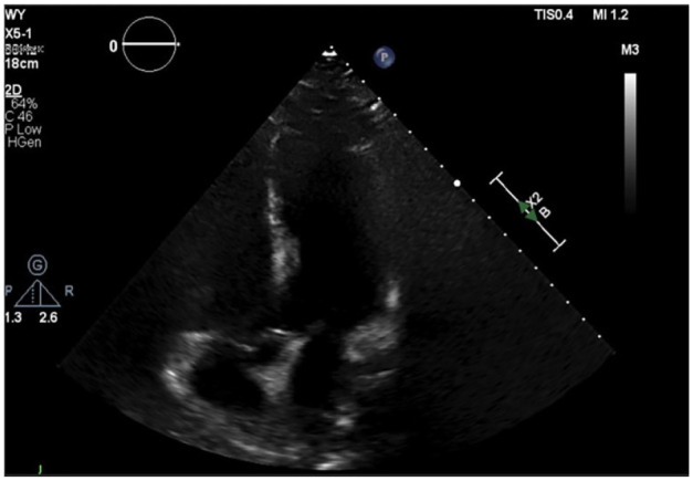 Rare Case of Acute Pancreatitis Presenting With ST-Segment Elevation.