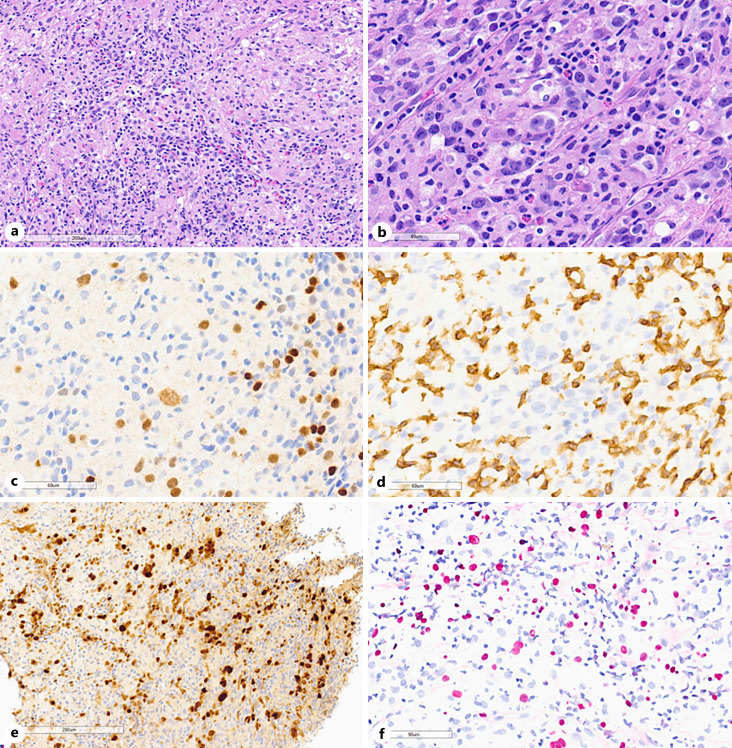 Nodal T-Cell Lymphoma Transdifferentiated from Mantle Cell Lymphoma with Epstein-Barr Virus Infection.