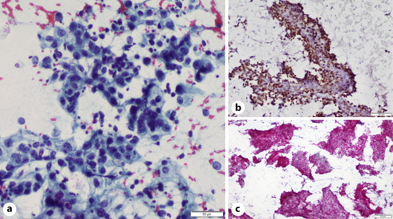 Diagnostic and Predictive Immunocytochemistry in Lung Cancer.