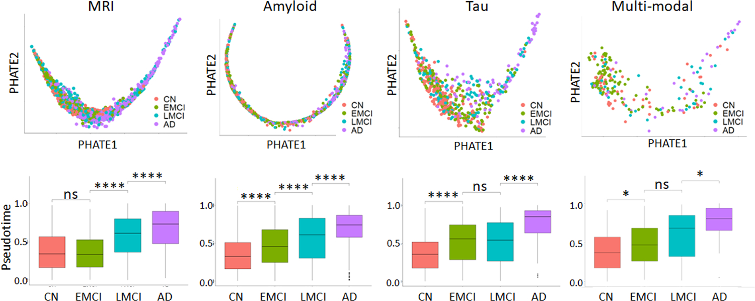 Multi-modal Imaging-based Pseudotime Analysis of Alzheimer progression.