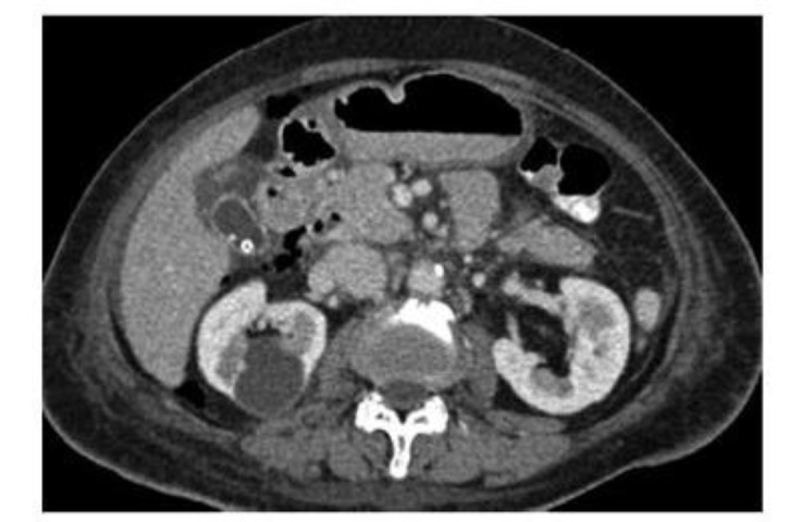 ERCP and complications of small bowel perforation.