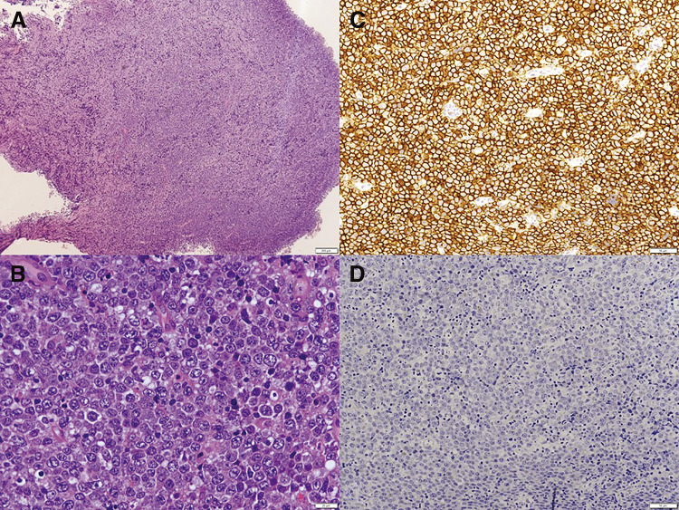 Invasion of Diffuse Large B-Cell Lymphoma to Right Axillary Arterial Graft.