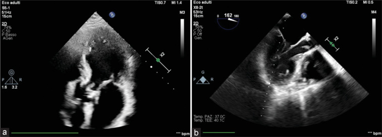 Complex Infective Endocarditis: Uncommon Presentations and Their Multisystem Complications - A Case Series.
