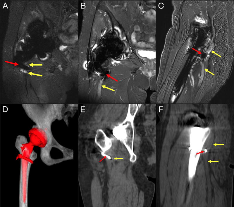 Profound Neuropathy after Penetrating Transection of the Sciatic Nerve by Femoral Cerclage Wire: Illustrative Case and Management Strategy.