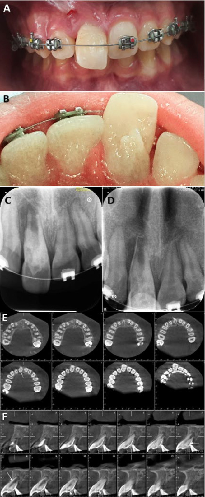 Nonsurgical Endodontic Treatment of Type IIIa Dens Invaginatus in an Immature Maxillary Central Incisor: A Case Report.