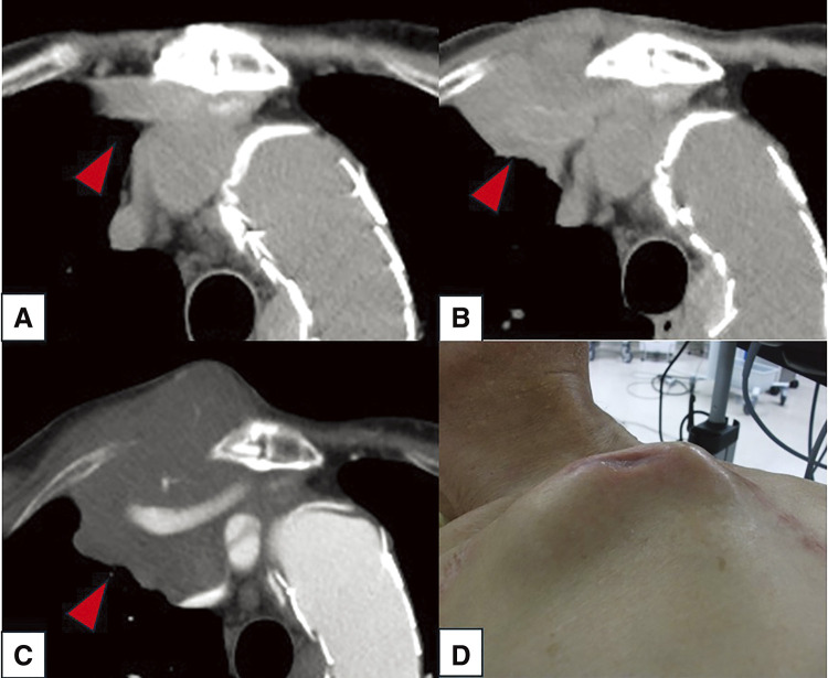 Invasion of Diffuse Large B-Cell Lymphoma to Right Axillary Arterial Graft.