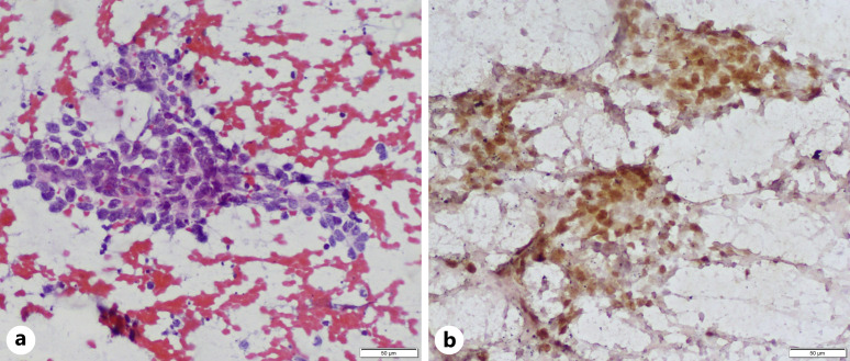 Diagnostic and Predictive Immunocytochemistry in Lung Cancer.