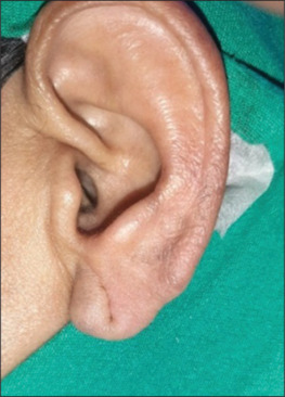 Efficacy of wound healing (Vrana Ropana) after lobuloplasty with and without panchavalkala extract. 5% w/v - randomized control trial.