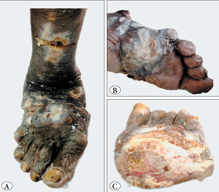 Carcinoma Cuniculatum Masquerading as Eumycetoma: An Unacquainted Entity Posing a Diagnostic Dilemma.