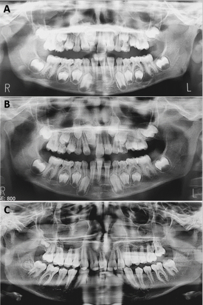 Nonsurgical Endodontic Treatment of Type IIIa Dens Invaginatus in an Immature Maxillary Central Incisor: A Case Report.