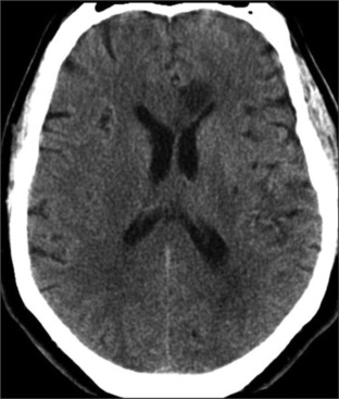 Delayed discovery of a frontal stroke causing depression.